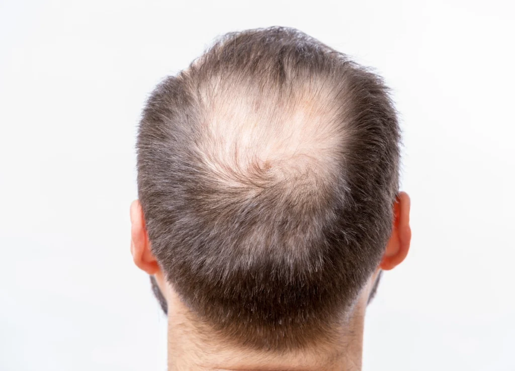 A picture of a bald scalp that could benefit from balding treatment such as PRP hair treatment