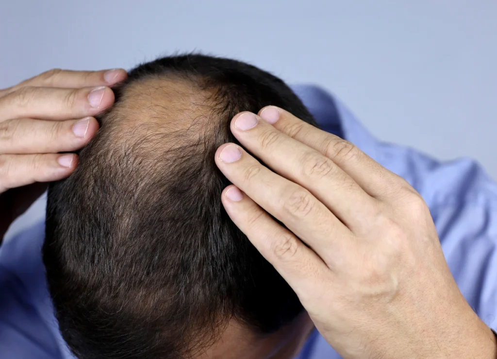 A picture of a balding man that may benefit from hair loss treatment