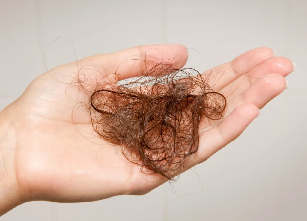 A picture of hair in a palm following hair loss