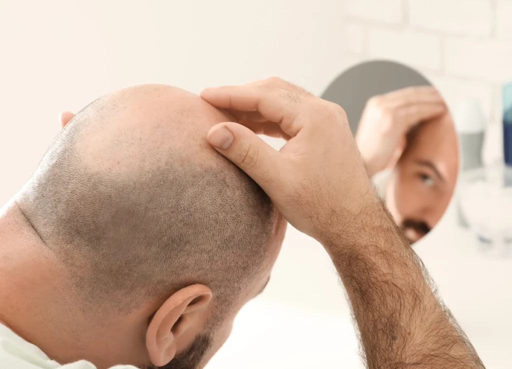 A Picture of a balding man in need of hair loss treatment