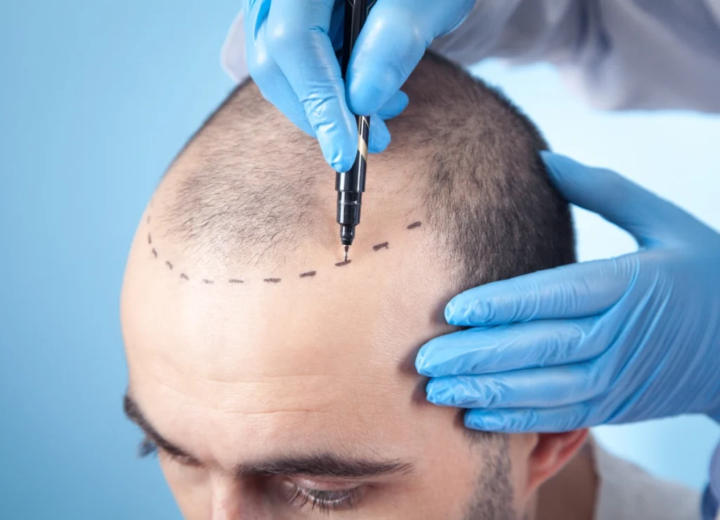 A Picture of the early begins of PRP Treatment for hair loss on an individual who is losing hair