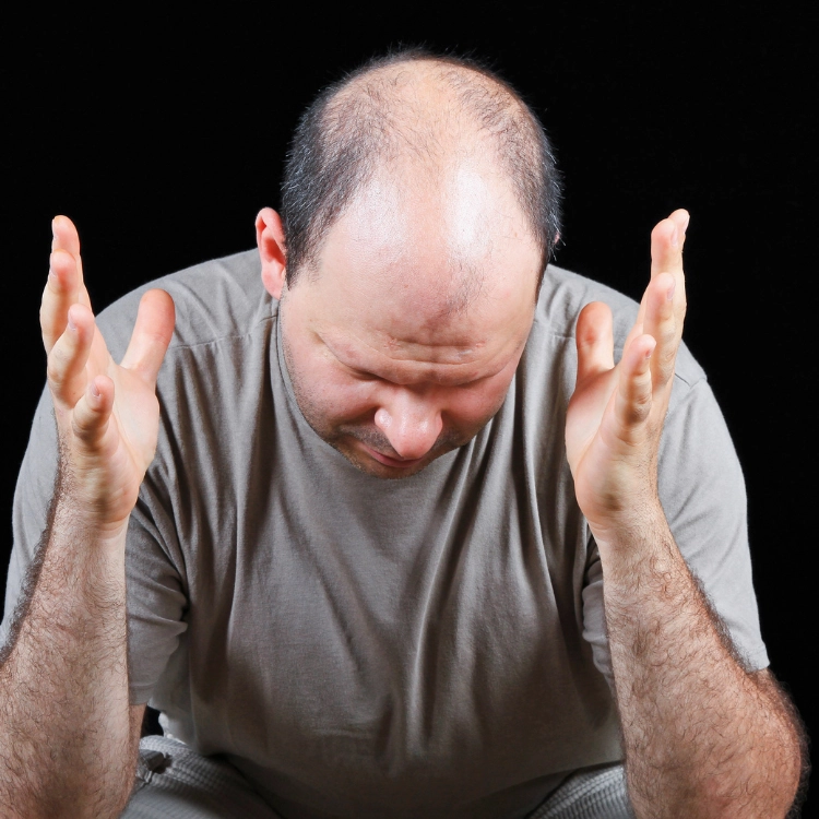 A picture of a man suffering from hair loss and needing hair loss treatment Coventry